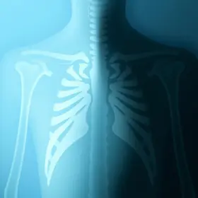 tuberculose